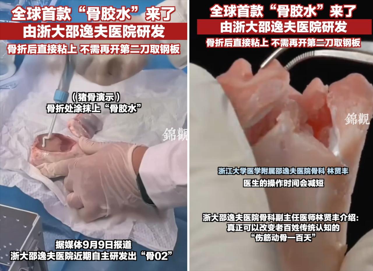 中国再次遥遥领先，浙江邵逸夫医院研发出了全球首款骨胶水“骨02”，直接打破骨科百