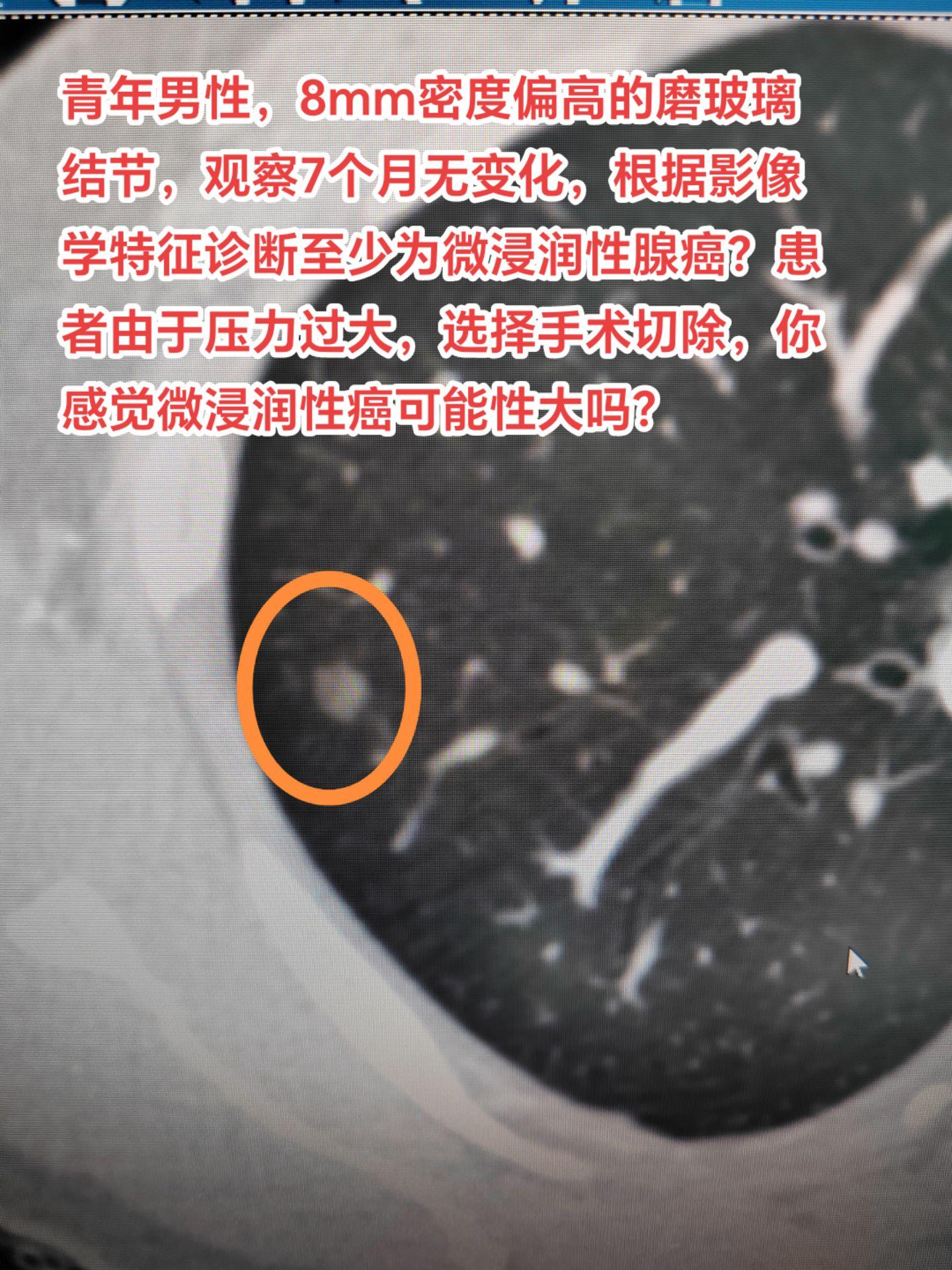 肺原位癌需要手术吗？有人说原位癌阶段是不需要手术的，但是现实是只要不把整个结节切除做病理就无法实现原位癌的病理学诊断，包括穿刺活检在内都是无法诊断原位癌的。所以如果影像学上怀疑原位癌是可以考虑观察的，但如果影像学特征上怀疑微浸润性癌阶段及以上的恶性结节可以根据实际情况决定切与不切。