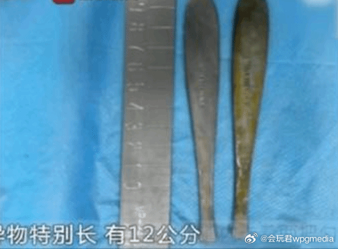 小伙腹痛CT查出肠道卡2把勺子 称吃东西时不慎吞下据荔枝新闻报道，近日，江苏南京