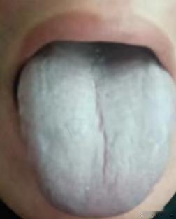舌苔白厚，你的舌头要长这个样子，补血要比祛湿还重要

主诉：消化不好，怕冷怕凉，