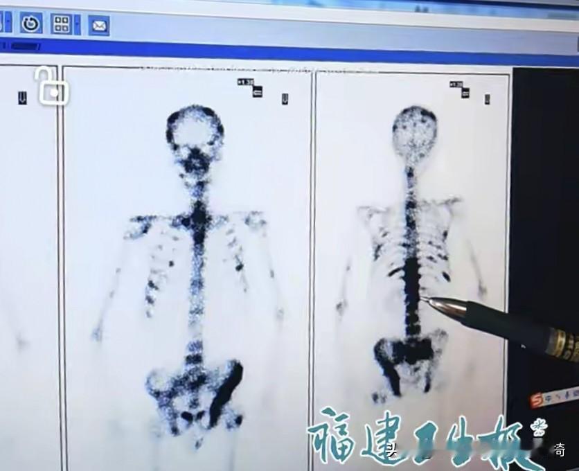 年年体检
还查出全身20多处肿瘤？
福建这位大爷的遭遇真给所有人敲了警钟！
 