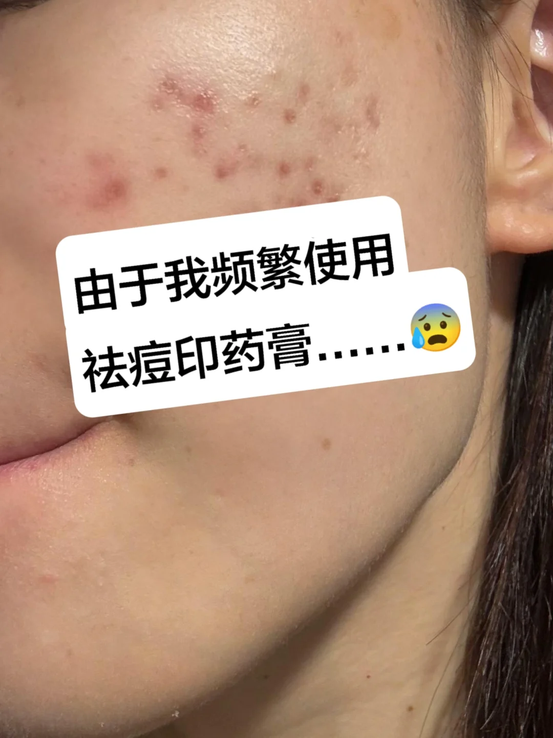 由于我长期用祛痘印药膏……