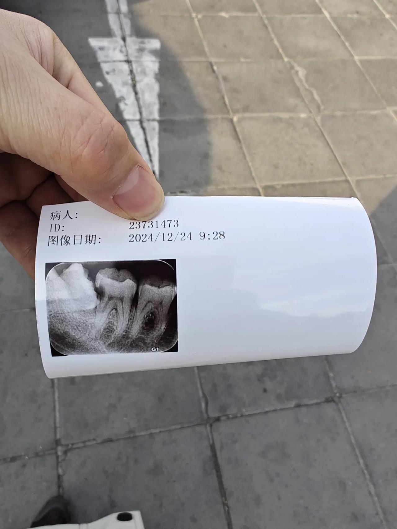 冬日生活打卡季牙齿不舒服一定要早去医院，越拖问题越大，到最后越不好处理。按时刷牙