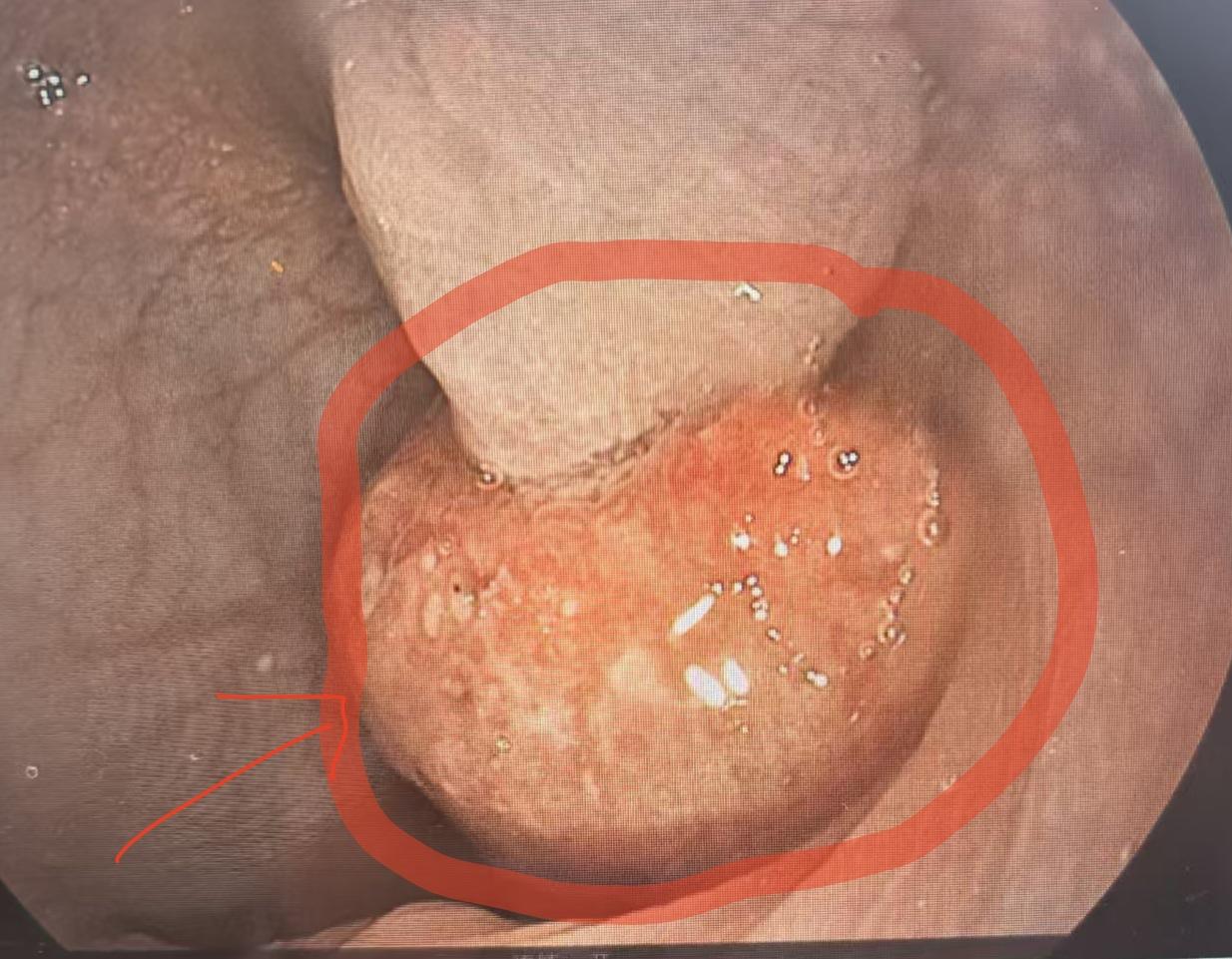 儿科医生手记：9岁男孩无痛血便，2厘米肠息肉，一场藏在平静下的隐患
临床工作多年