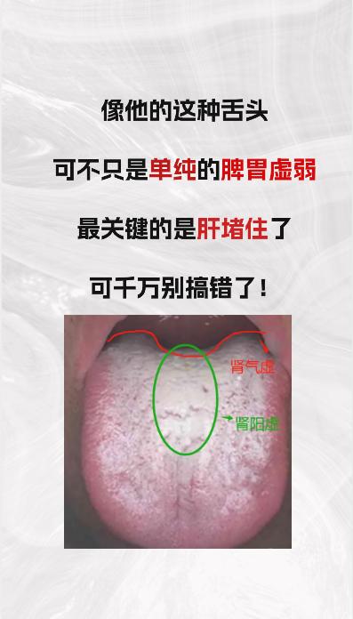 像他这种舌头，可不只是单纯的脾胃虚弱，最关键的是“ 肝堵住了 ”，千万别搞错了