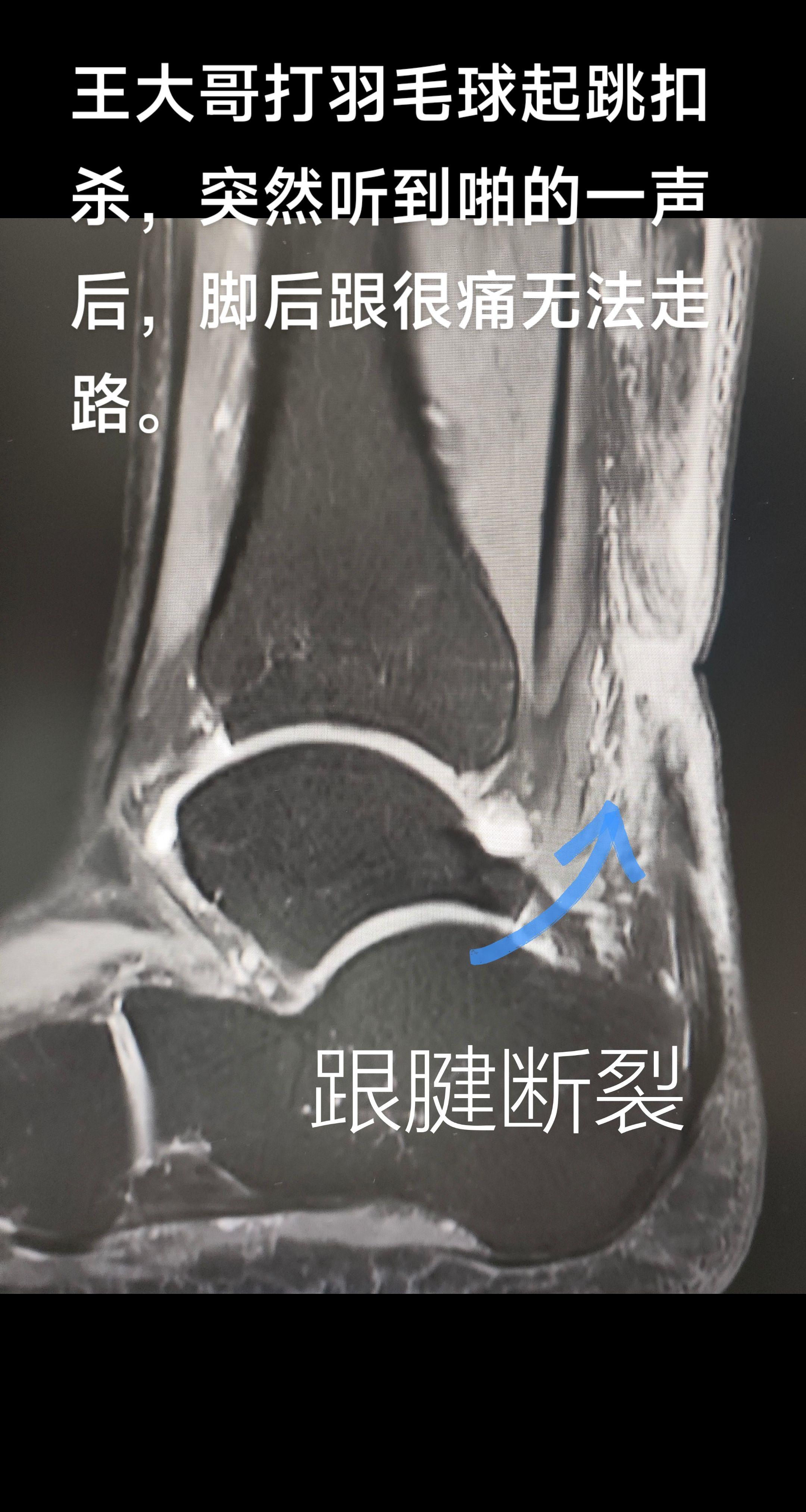 跟腱断裂。