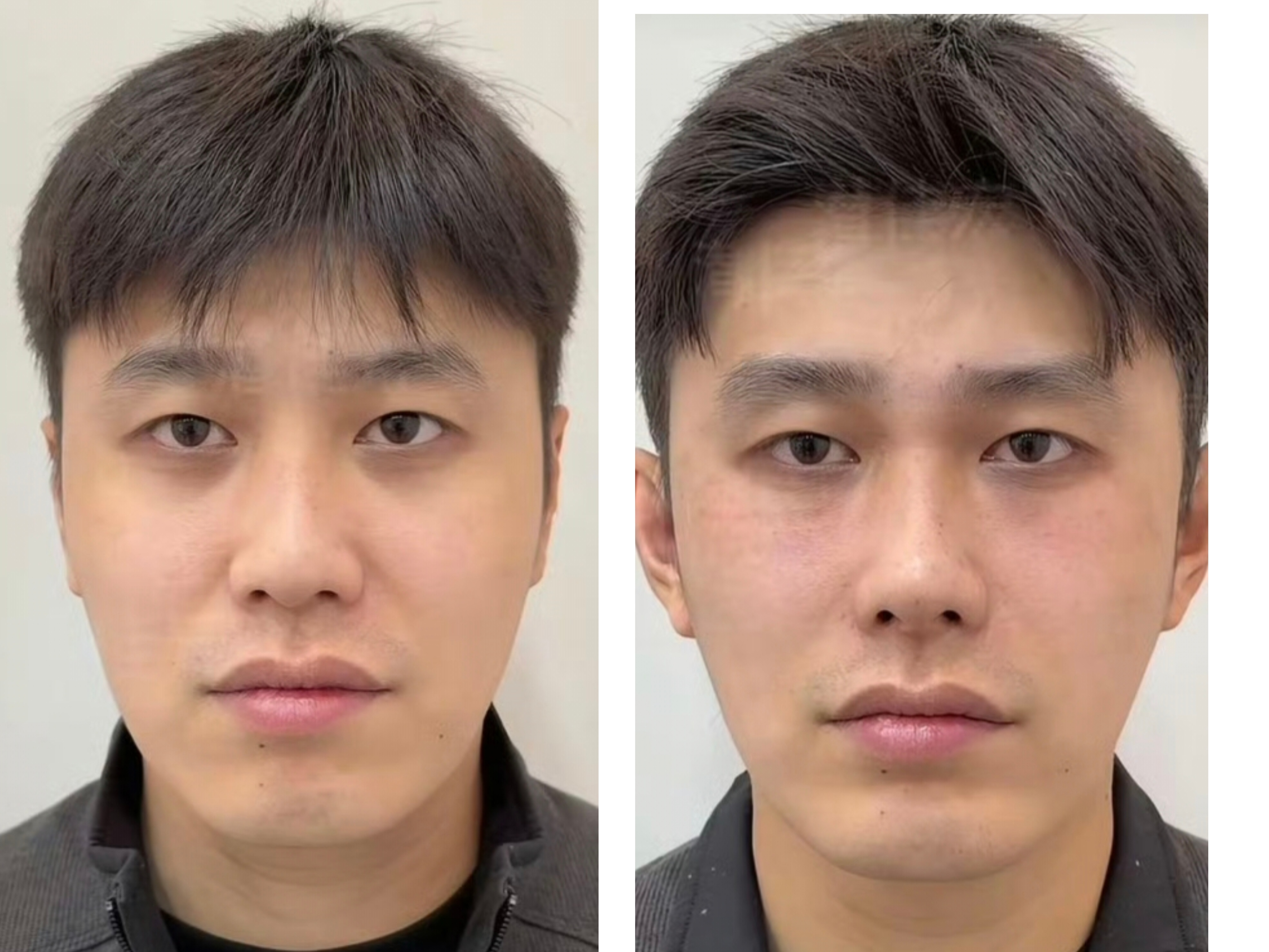 万宁叔整容 搞不懂为啥都要去整容呢？自然一点真实一点不好吗？运动减肥瘦下来就很好