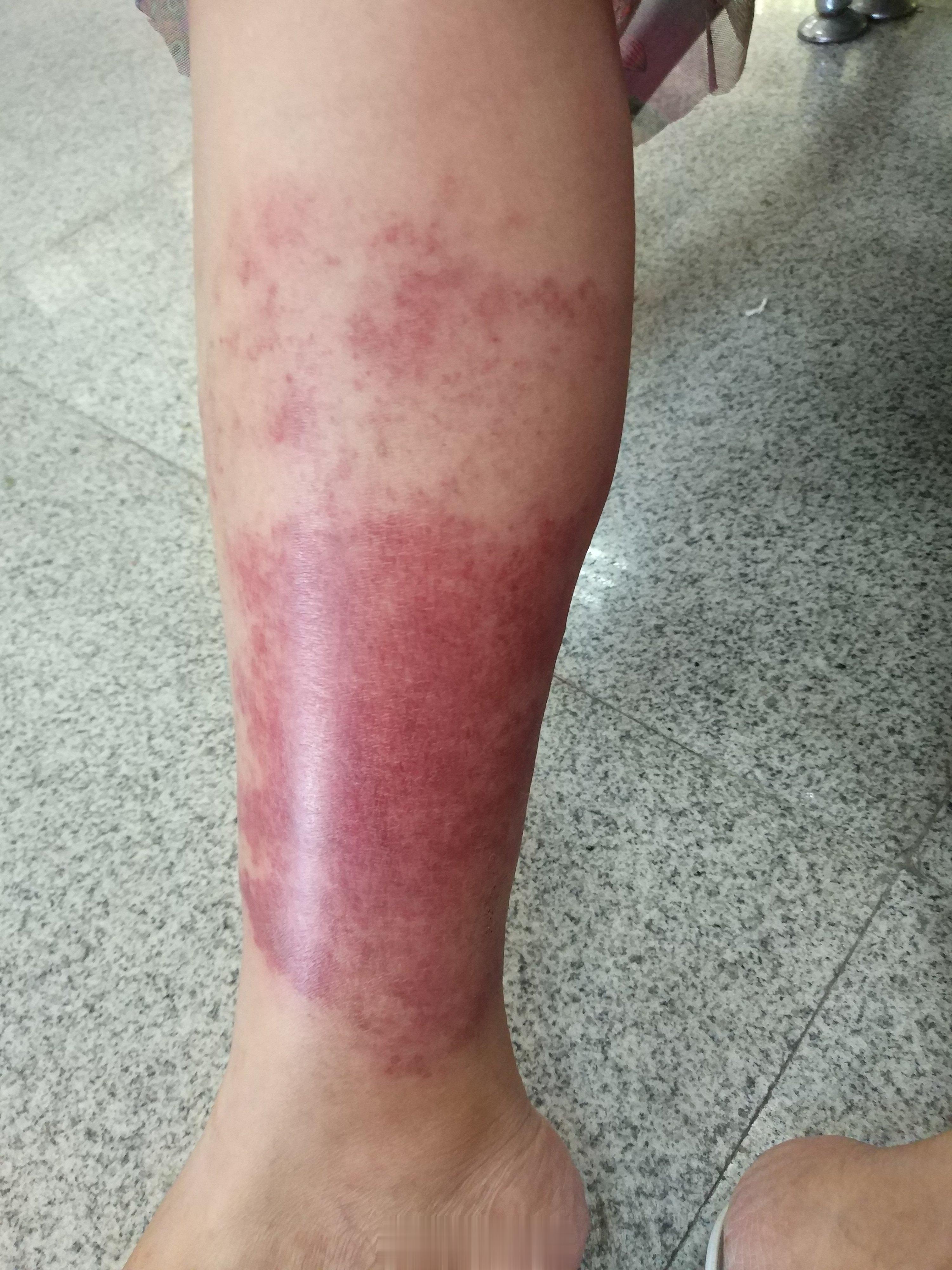 #小伙称因长期抠鼻子感染丹毒#丹毒就是一个叫做乙型溶血性链球菌的细菌感染，主要见
