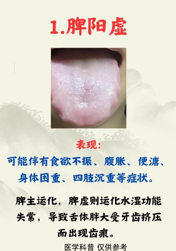齿痕舌的 5 种常见证型，对照自查