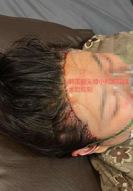 我再说一遍任何时候我都很提倡额头缩小和发际线一起做（如果两项真的都刚需）为什么？