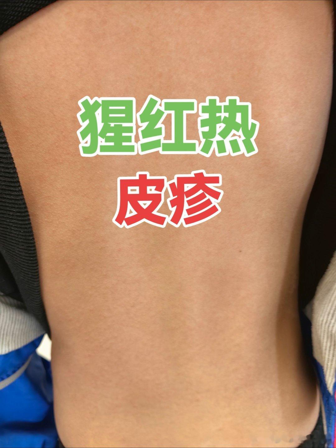 春夏之交，发热+嗓子肿痛+皮疹，警惕猩红热。链球菌感染猩红热  ​​​