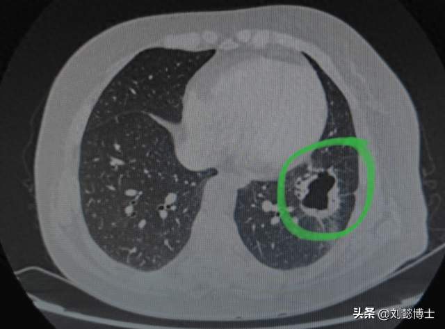 刘懿博士说肺癌（一二一一八）4cm肺囊腔壁不光滑很僵硬是癌么？