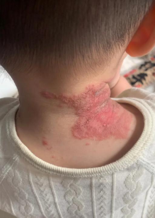 只是睡了一觉，宝宝脖子就被虫子咬出一大片红
为人父母最见不得孩子皮肤受罪，一觉醒