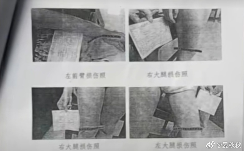 令人发指弟弟被逼吃大便、被用开水烫下体、全身淤青面积超过体表47%，姐弟两人常饿