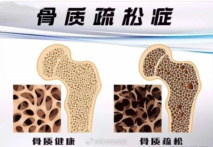 骨质疏松正呈现年轻化趋势骨质疏松年轻化，本质是一场被审美和工位合谋的慢性透支。当