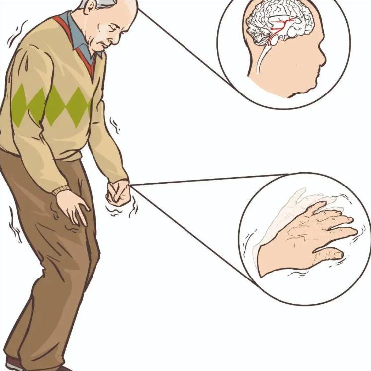 偏瘫为什么腿能走路了，胳膊还是不听使唤？今天把原因说清楚

很多脑卒中患者都有这