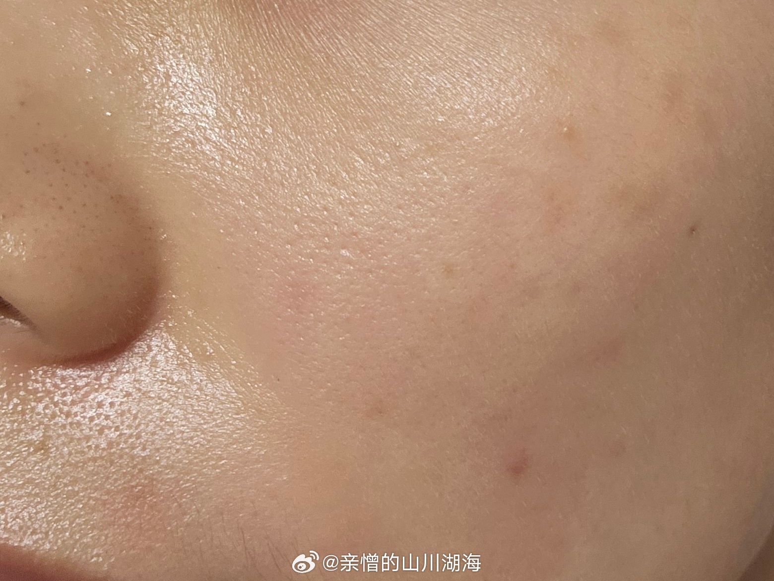 爱适乐肤一辈子[送花花]抛开医生推荐不说，就是它这个水敷几分钟，再涂乳液或者面霜
