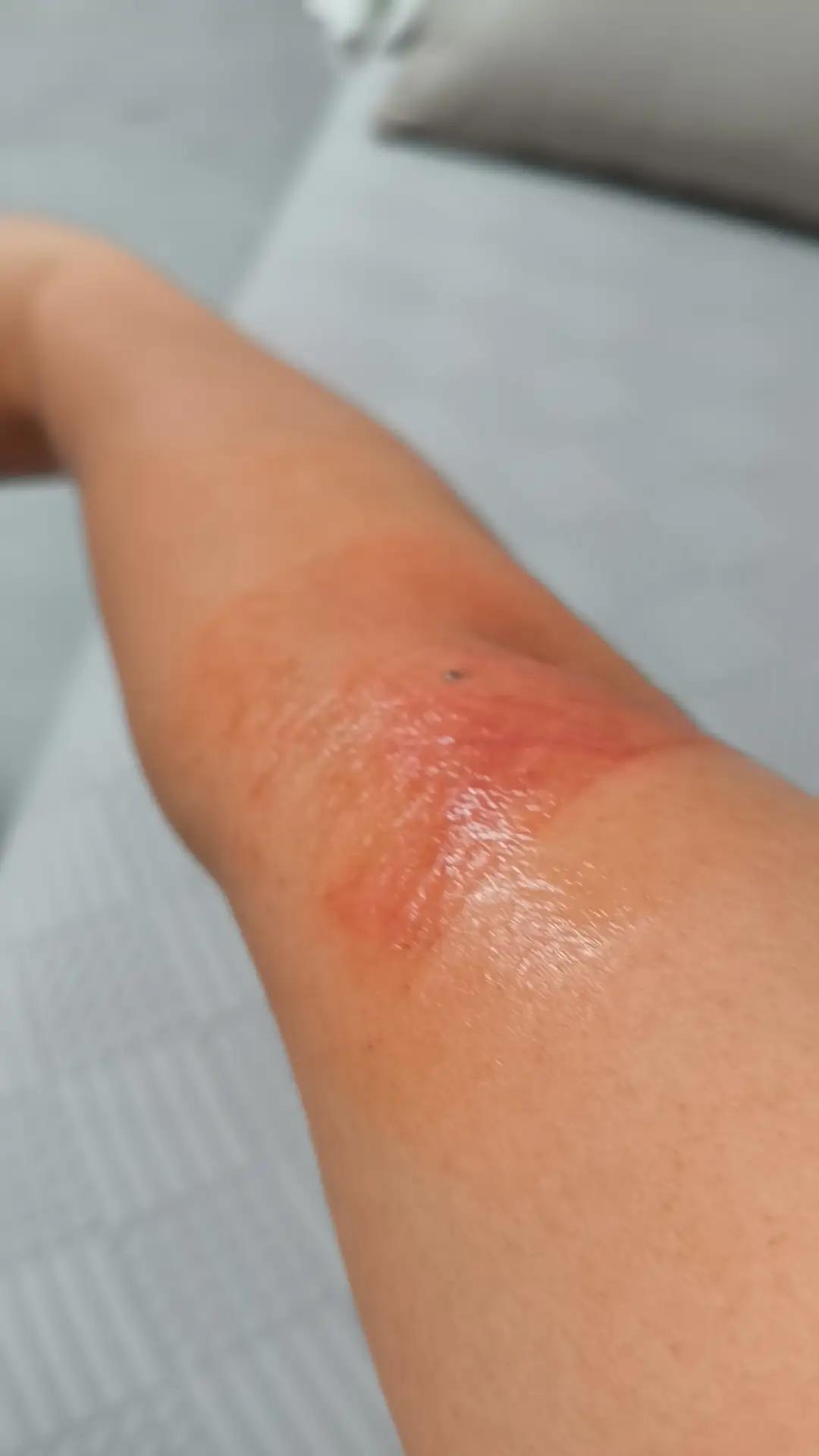 贴膏药贴过敏了，烤电把皮肤考胡了，你们说，我除了自残还能干点啥？