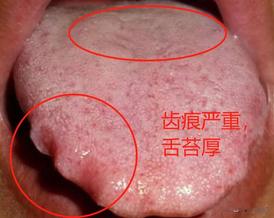 又是有齿痕的舌苔，看见这个舌头就头疼，朋友们，单纯的脾虚很少见了，你这些问题不解