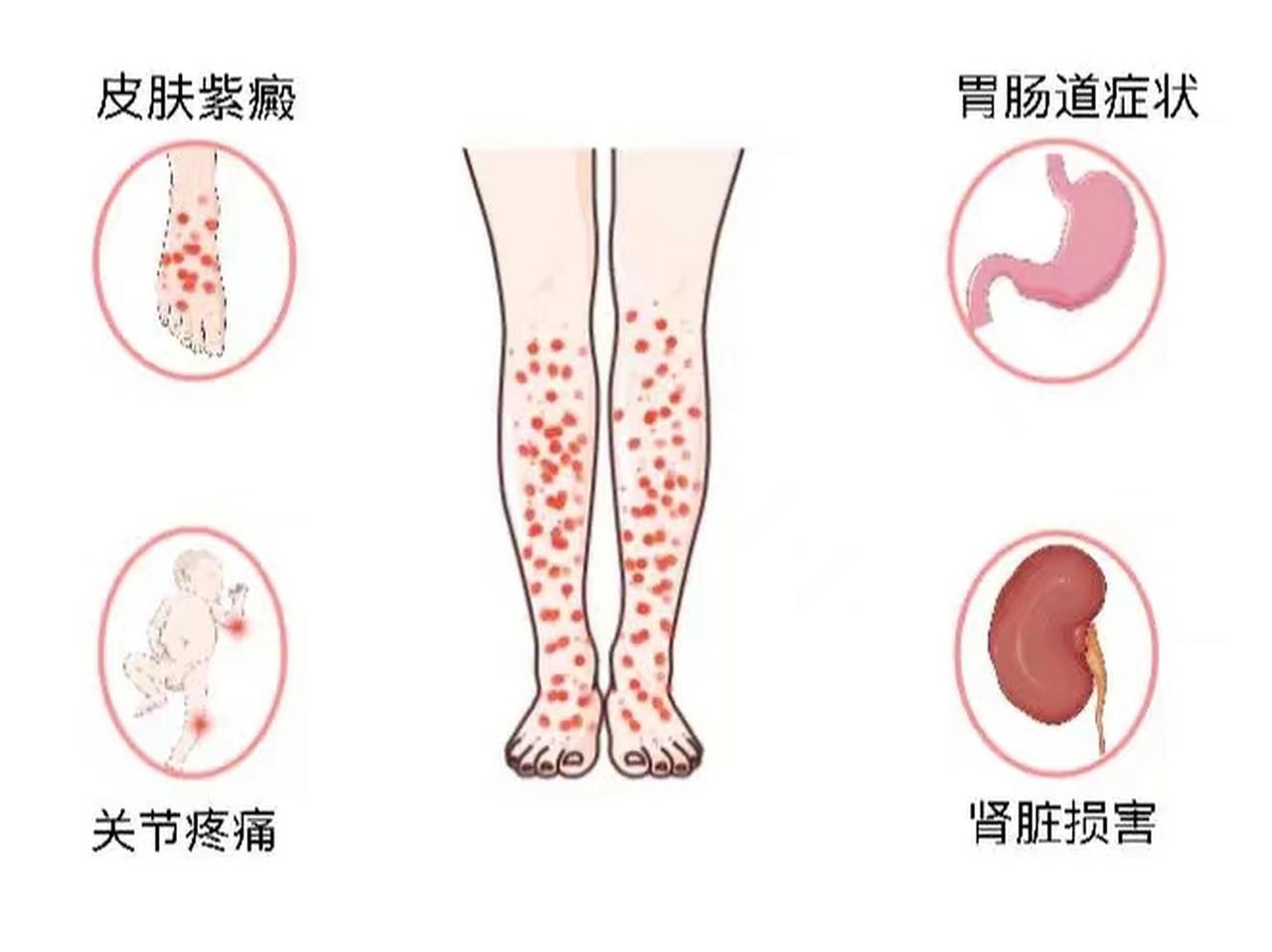 血小板减少性紫癜注意事项有哪些

血小板减少性紫癜应注意卧床休息，不要剧烈运动，