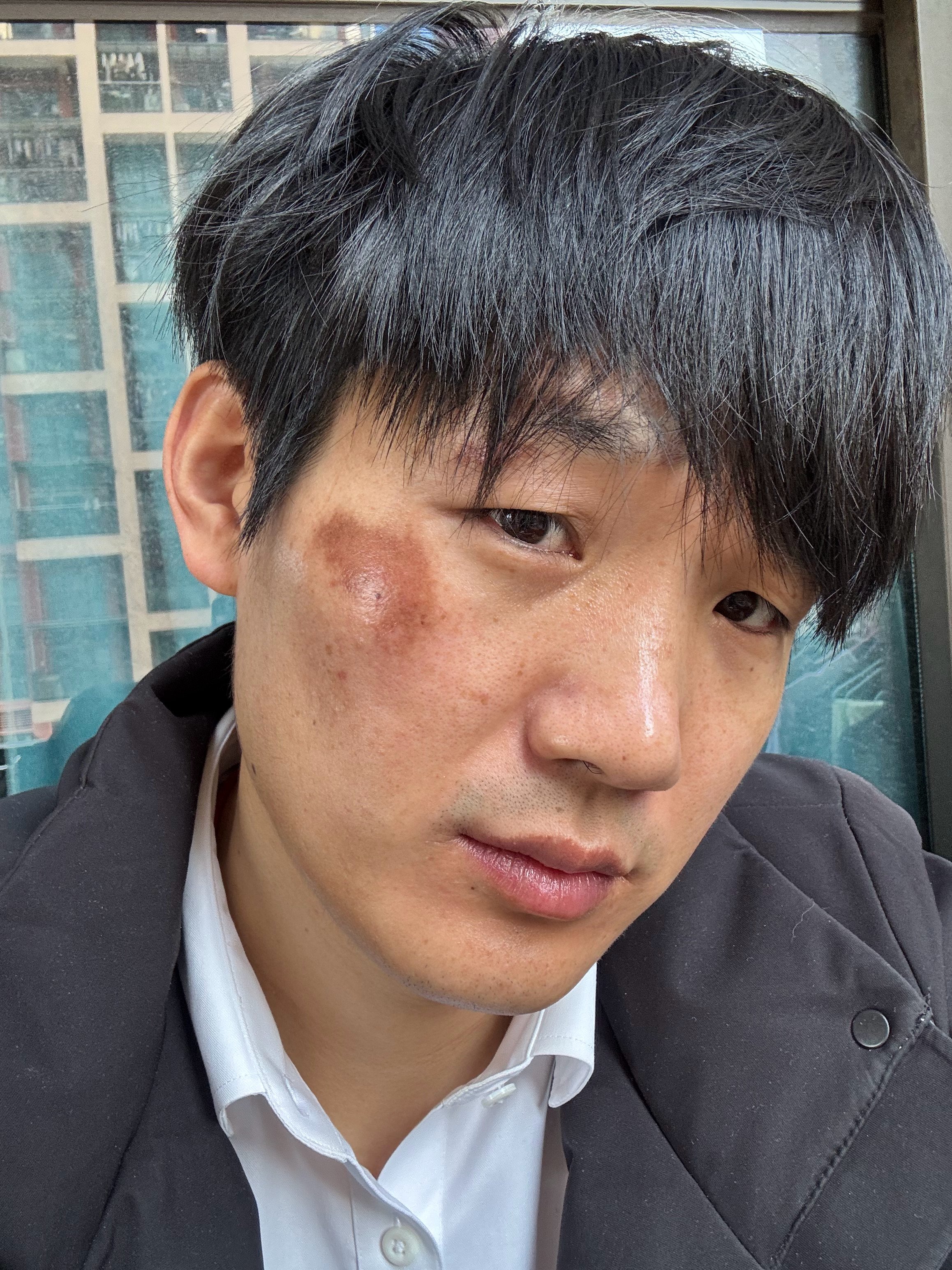 明天再上一天班，后天放假1天，只希望摔伤留下的这片黑，快快消退，厄运退，退，退，