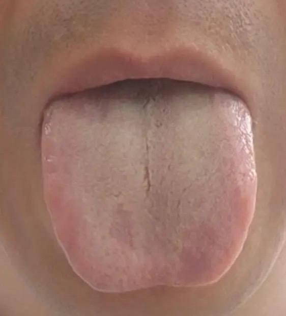 舌中间一条裂纹，别再误判脾肾阳虚！其实问题在肝！

很多人舌中间出现一条裂纹，第