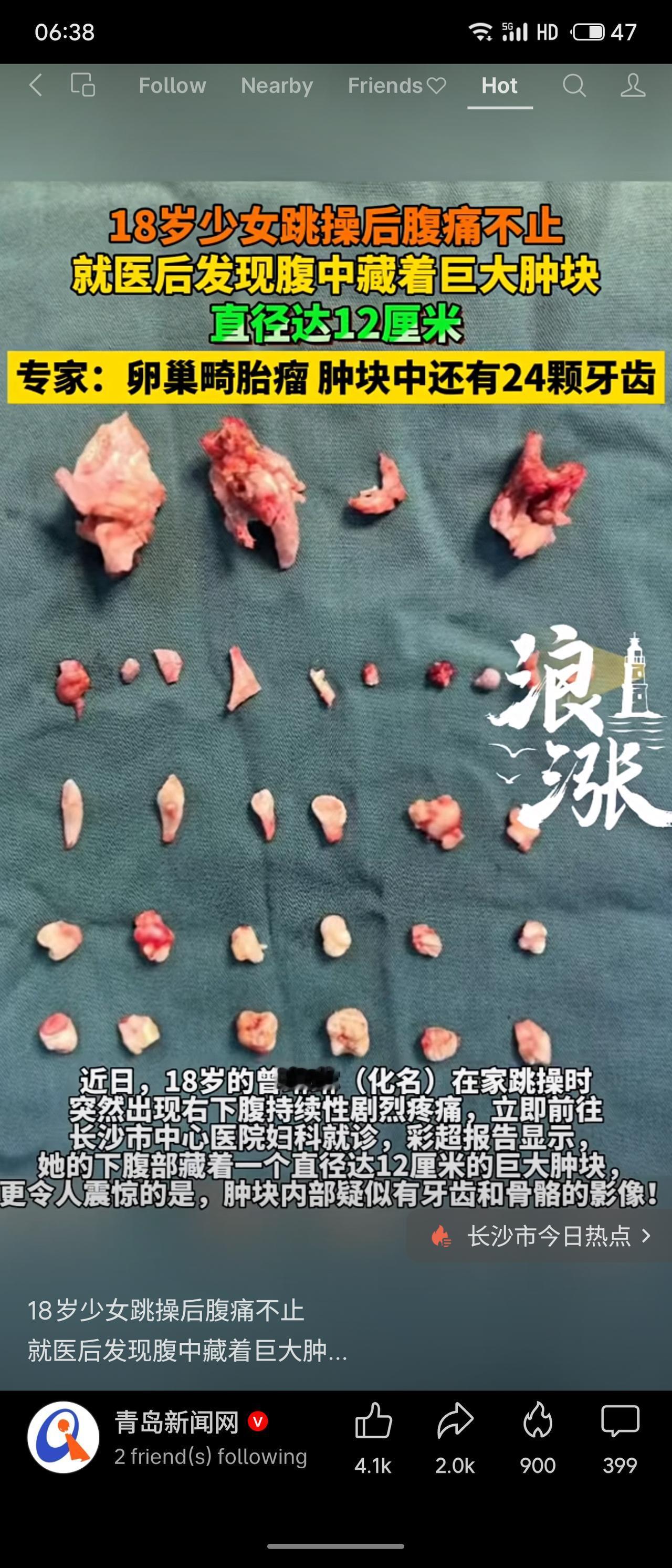 记录我的202618岁少女跳操后腹痛不止，就医发现腹中藏12厘米卵巢畸胎瘤，内含