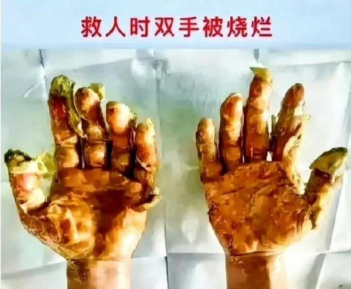 19岁消防员张国炜，在救火现场奋不顾身地救了7个人，自己却被火焰重度烧伤。致敬英