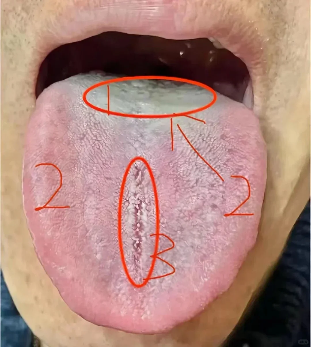 湿热，肝郁化火，脾气虚
