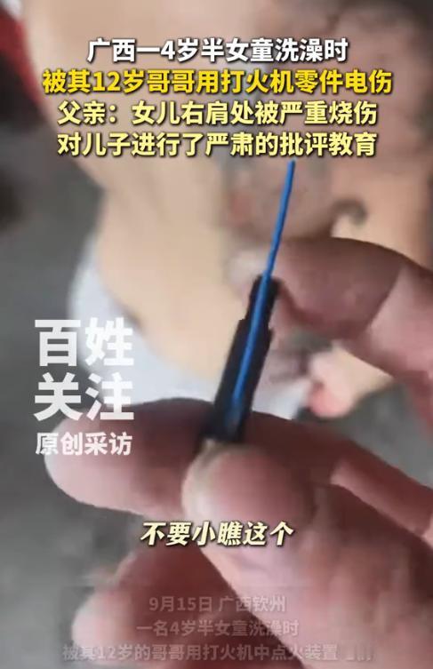 家长可得注意了！广西一4岁半女童洗澡时，竟被其12岁哥哥无意用打火机零件电伤，造