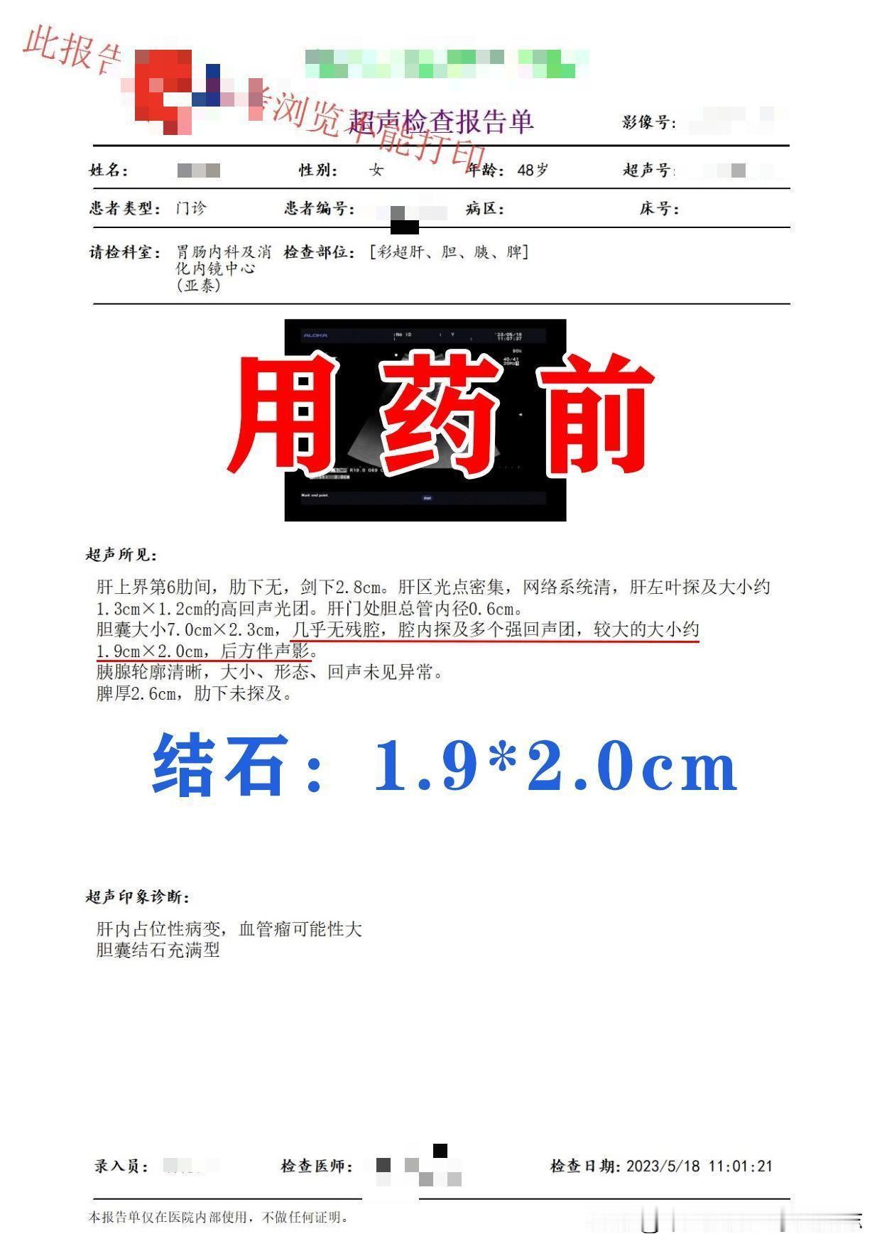 唐女士48岁，患者几年前检查时就发现有胆结石，当时较小，没有太在意，最近一段时间