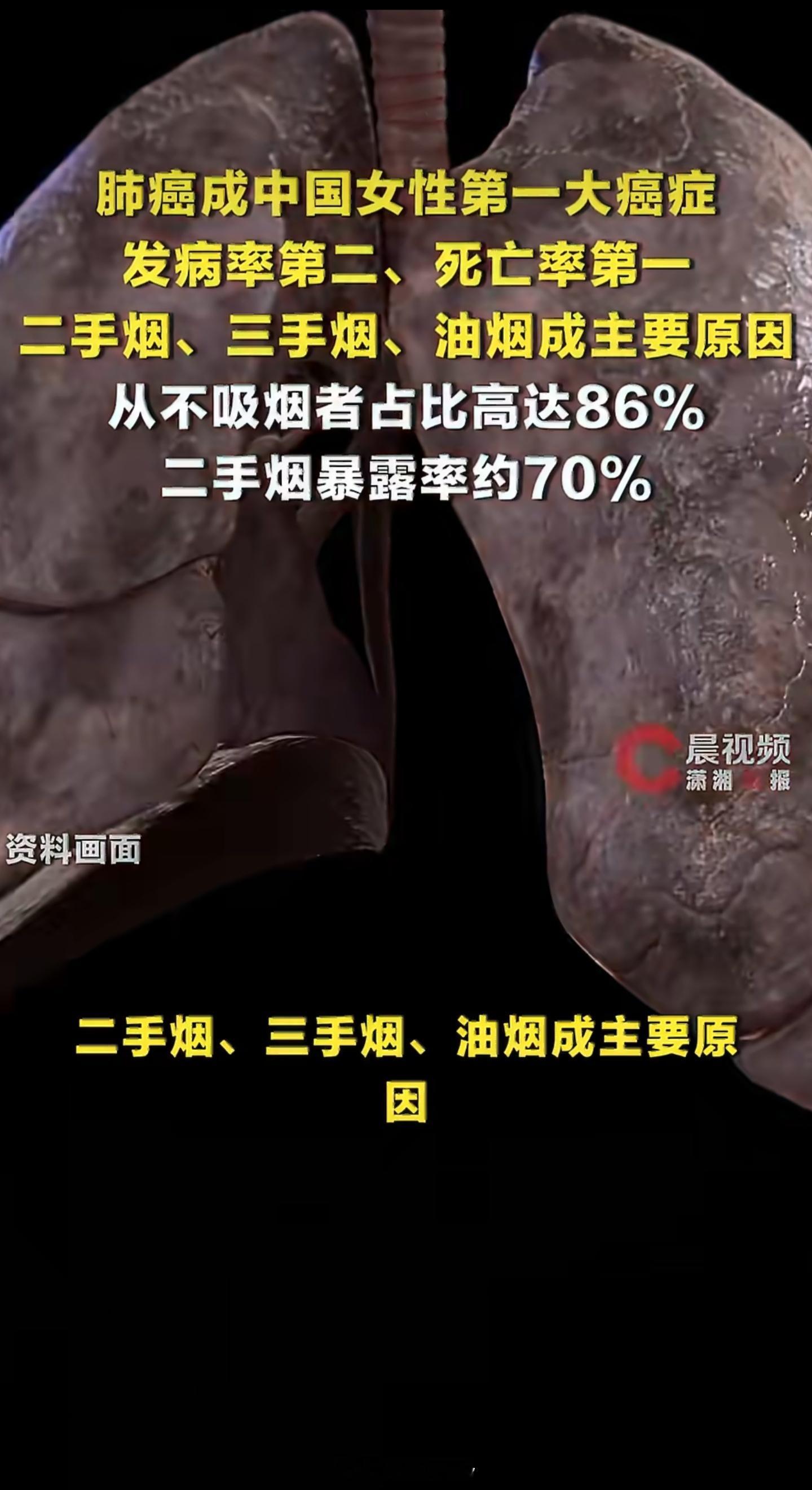 肺癌成中国女性第一大癌症其实是二手烟在悄无声息地伤害她们的身体。很多人应该都遇到