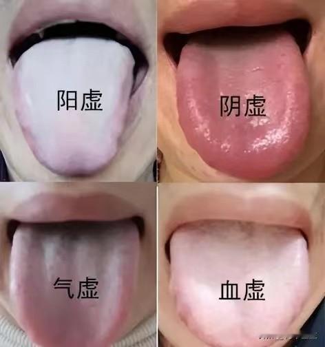 人体四大虚，辨别很简单，从舌头上就能看出来，一分钟教你学会

1. 阳虚
舌象：
