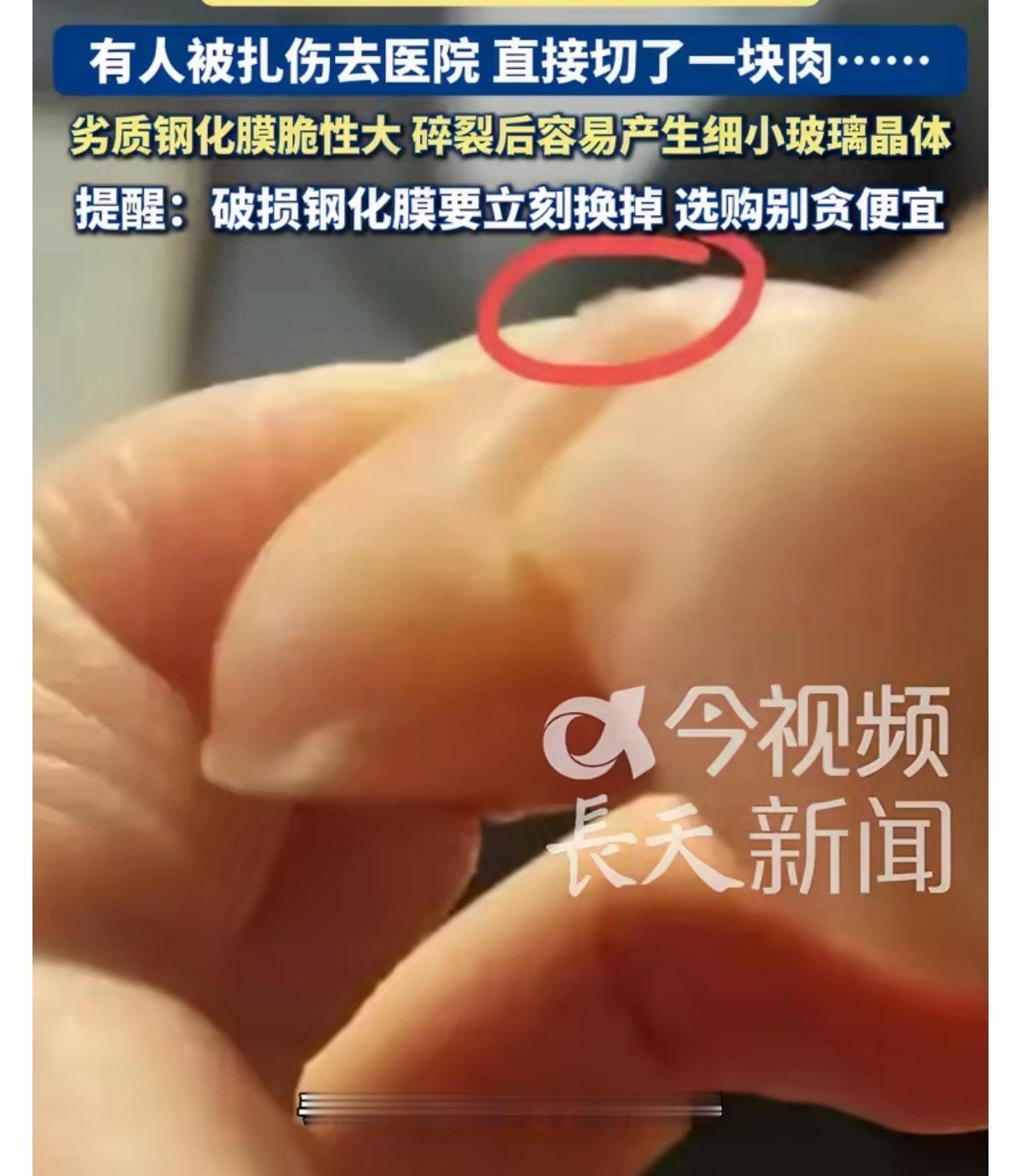 女子玩手机被钢化膜碎片扎伤看了下，手机钢化膜裂了还舍不得换，觉得不影响触控就凑合