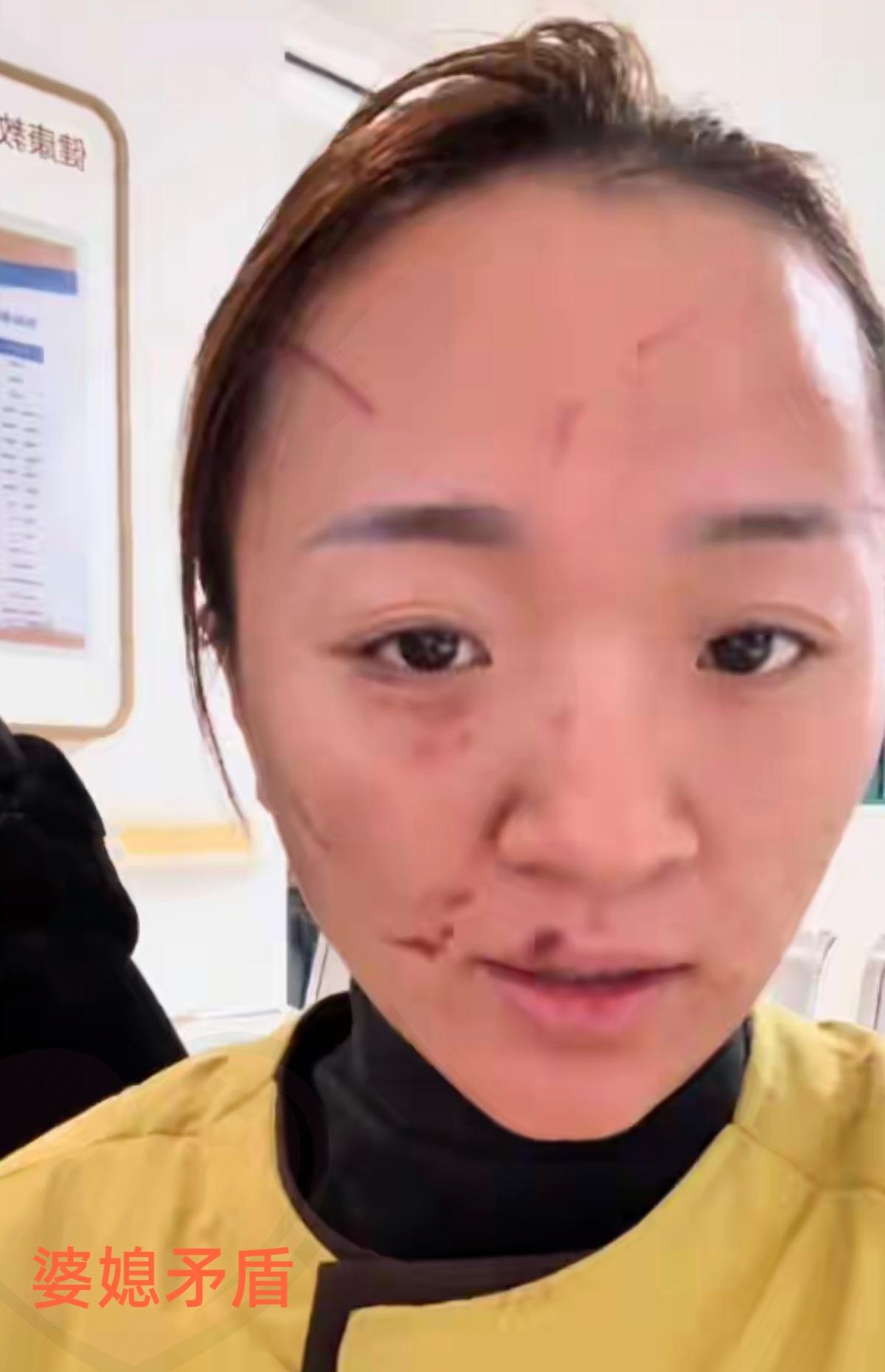 宁波女子被婆婆抓得满脸是伤，丈夫和公公全程围观，这哪是家庭矛盾，分明是寒了人心！