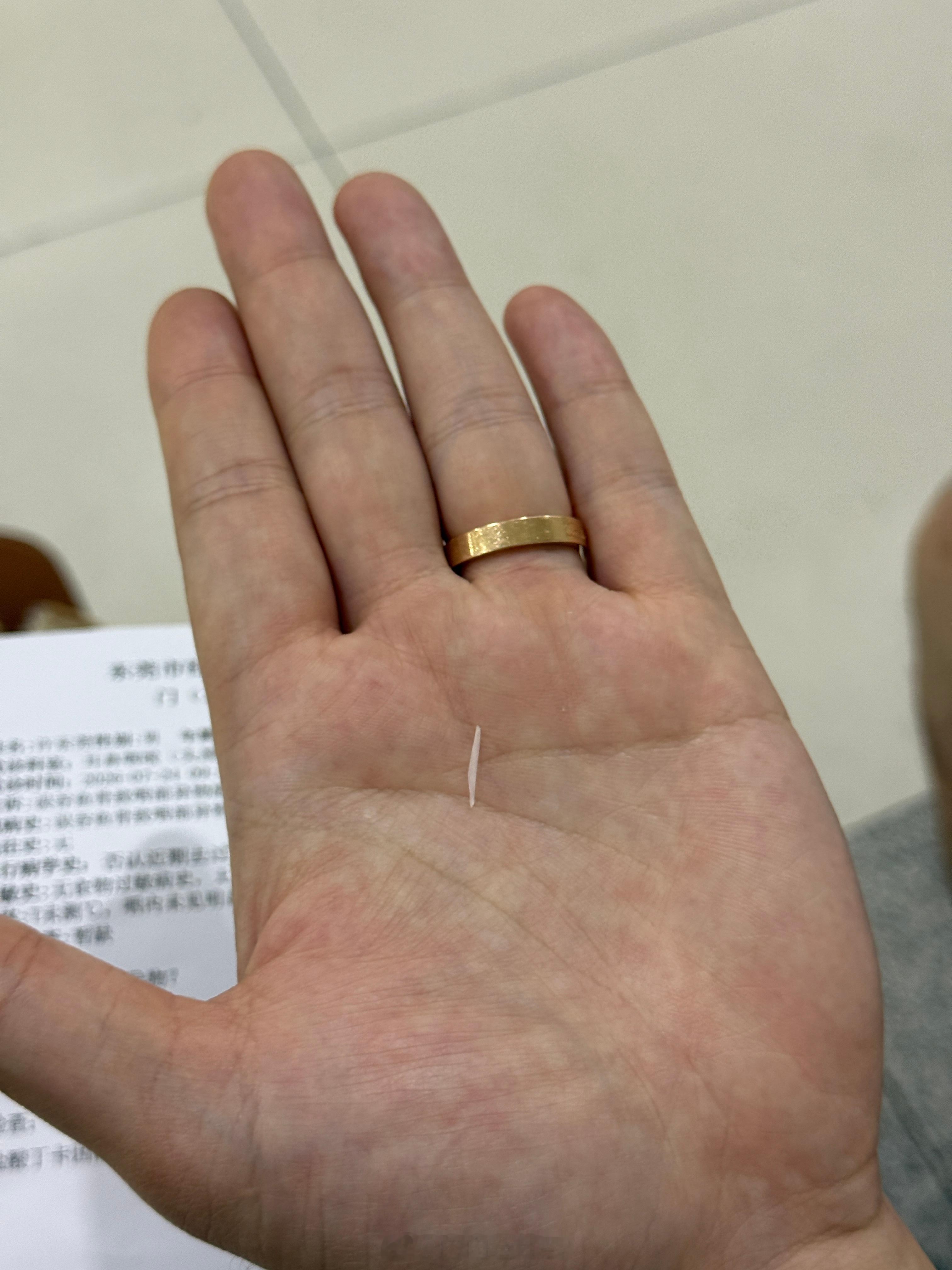 老猫烧须，卡了根鱼骨喷了2次麻药，插了2次管才夹出来，巨难受鱼骨米粉爱好者的我，
