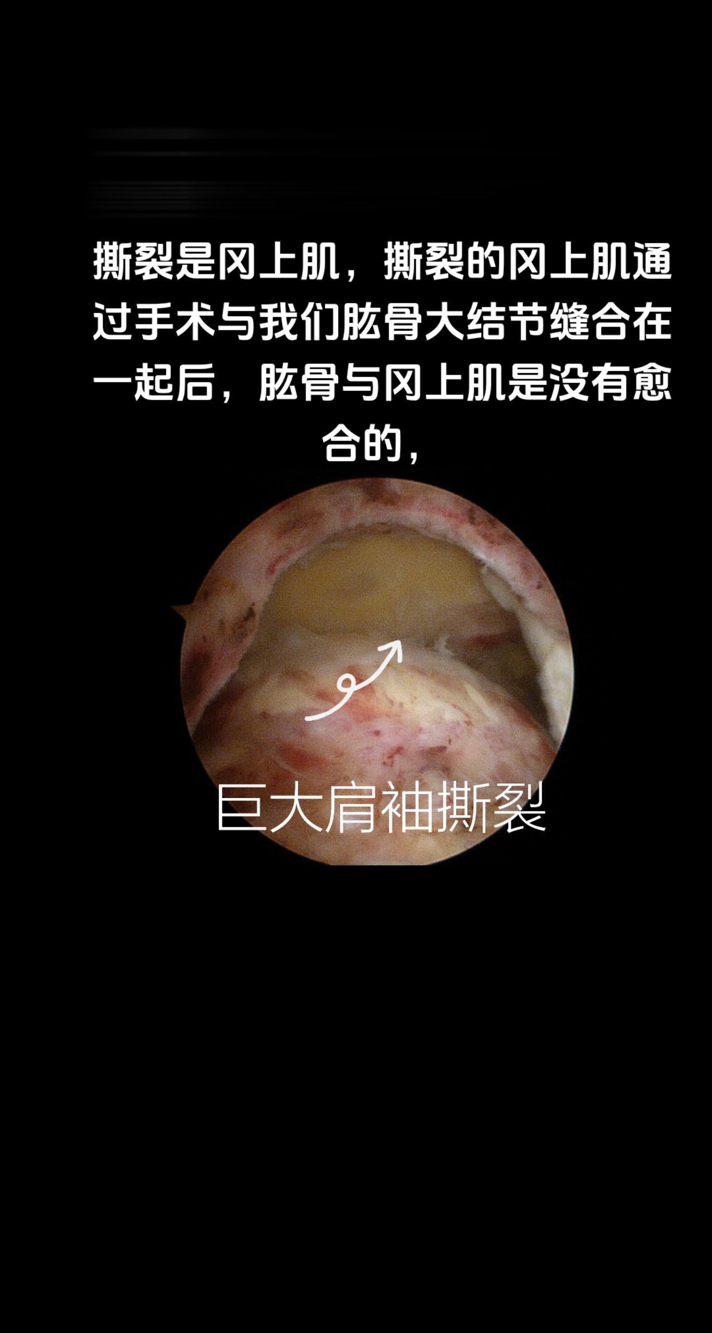 肩袖撕裂修补术后为什么要带外展支具？肩袖撕裂