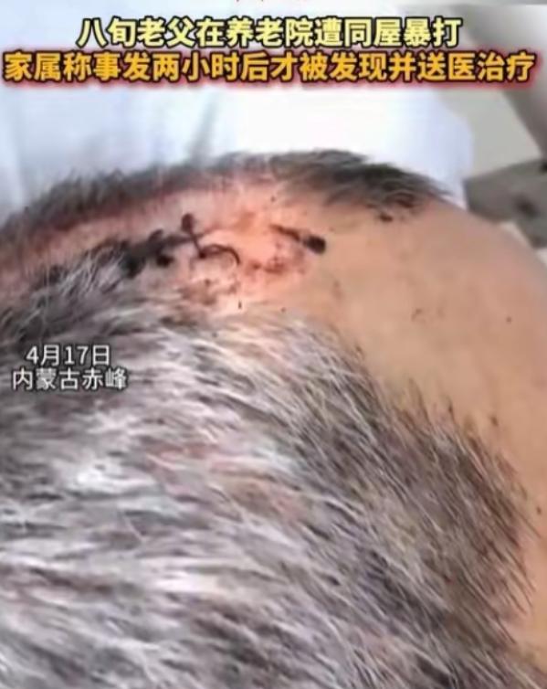 “必须严惩！” 内蒙古赤峰，女子将父亲送到养老院，几天后去接，只见父亲裤子直接裂