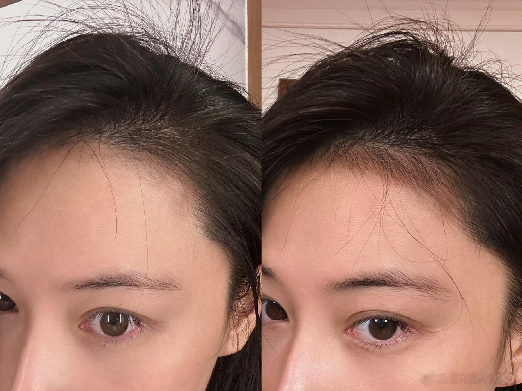 张馨予消失的头发回来了 不是，发际线真能养回来啊！！姐姐求教程，我很需要[泪][