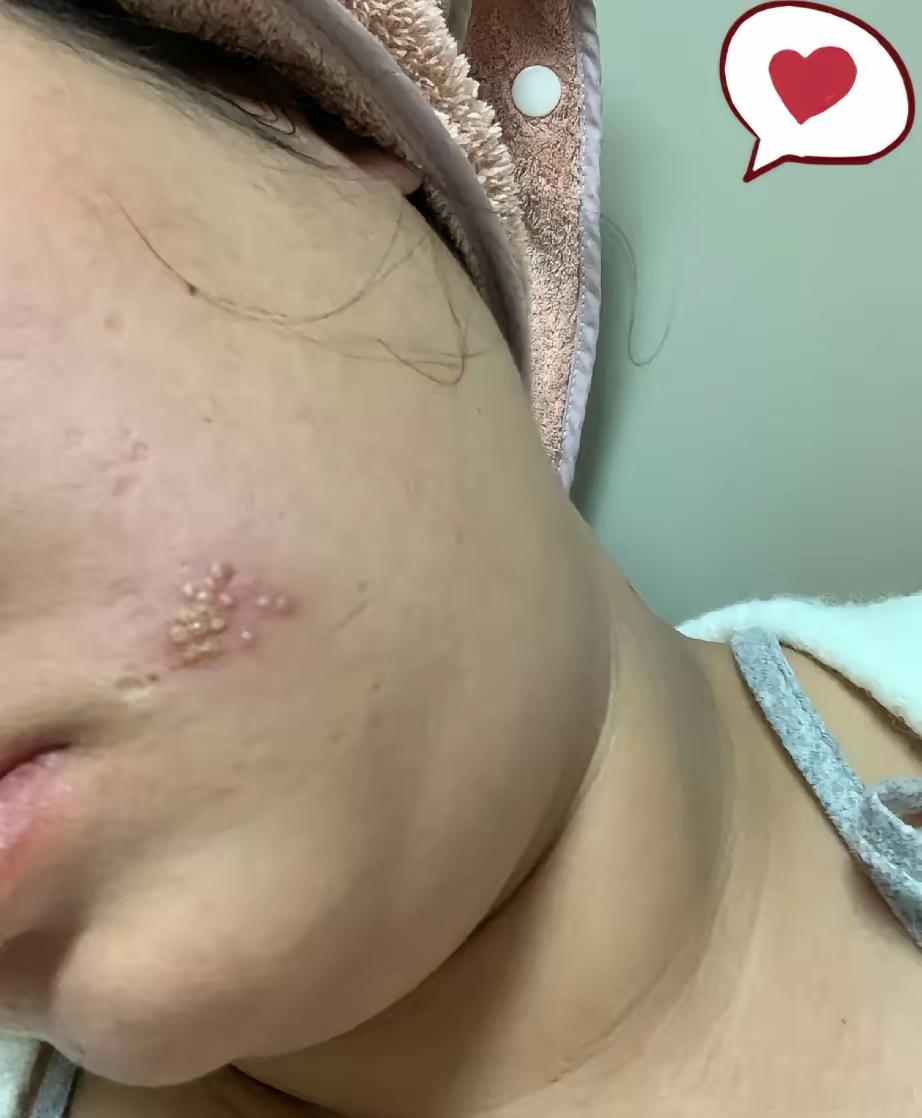 家人们这长的啥呀？不像青春痘啊，还好疼，有友友知道这是什么吗？ 