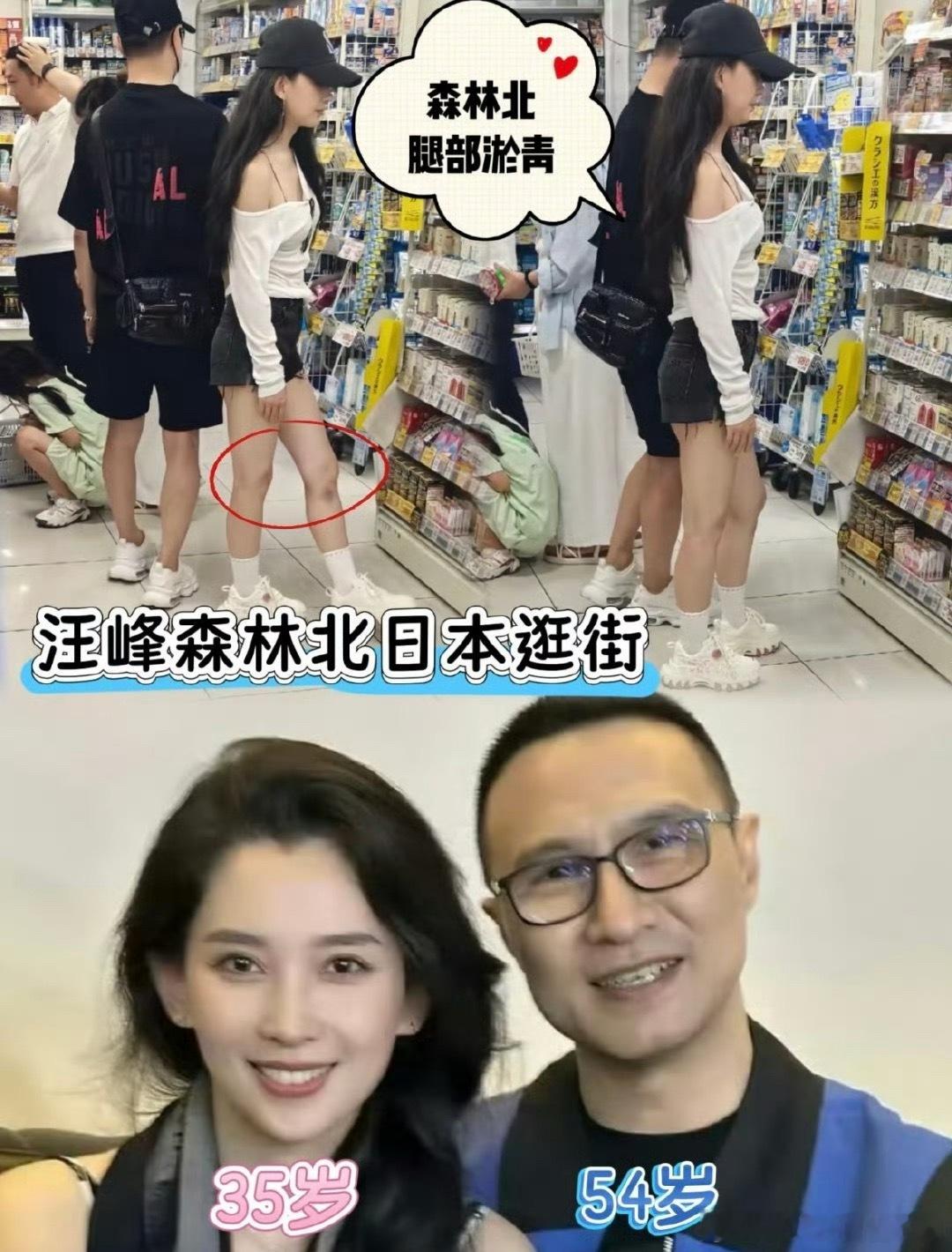 森林北腿部大片淤青疑受伤应该是不小心碰着了吧，姐姐可得好好照顾自己呀！她那温柔感