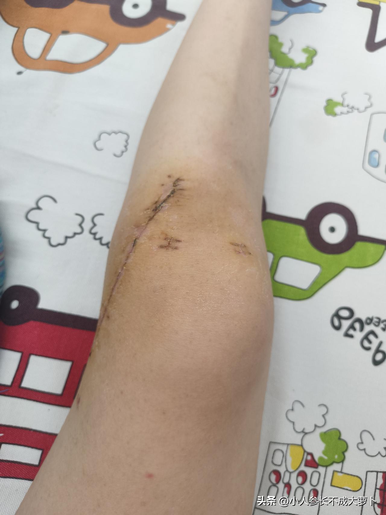 为啥手术后伤口附近都要掉一层皮？！
昨天看到医生说，碘伏消毒之后其实是需要擦掉的