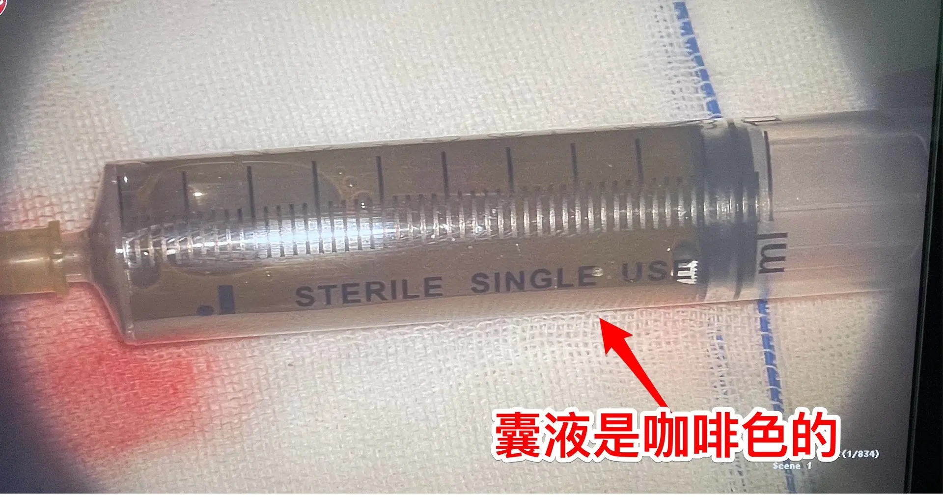 男生高考后想打工，居然发现脑部长瘤了。18岁四川男生，高考后到北京来投...