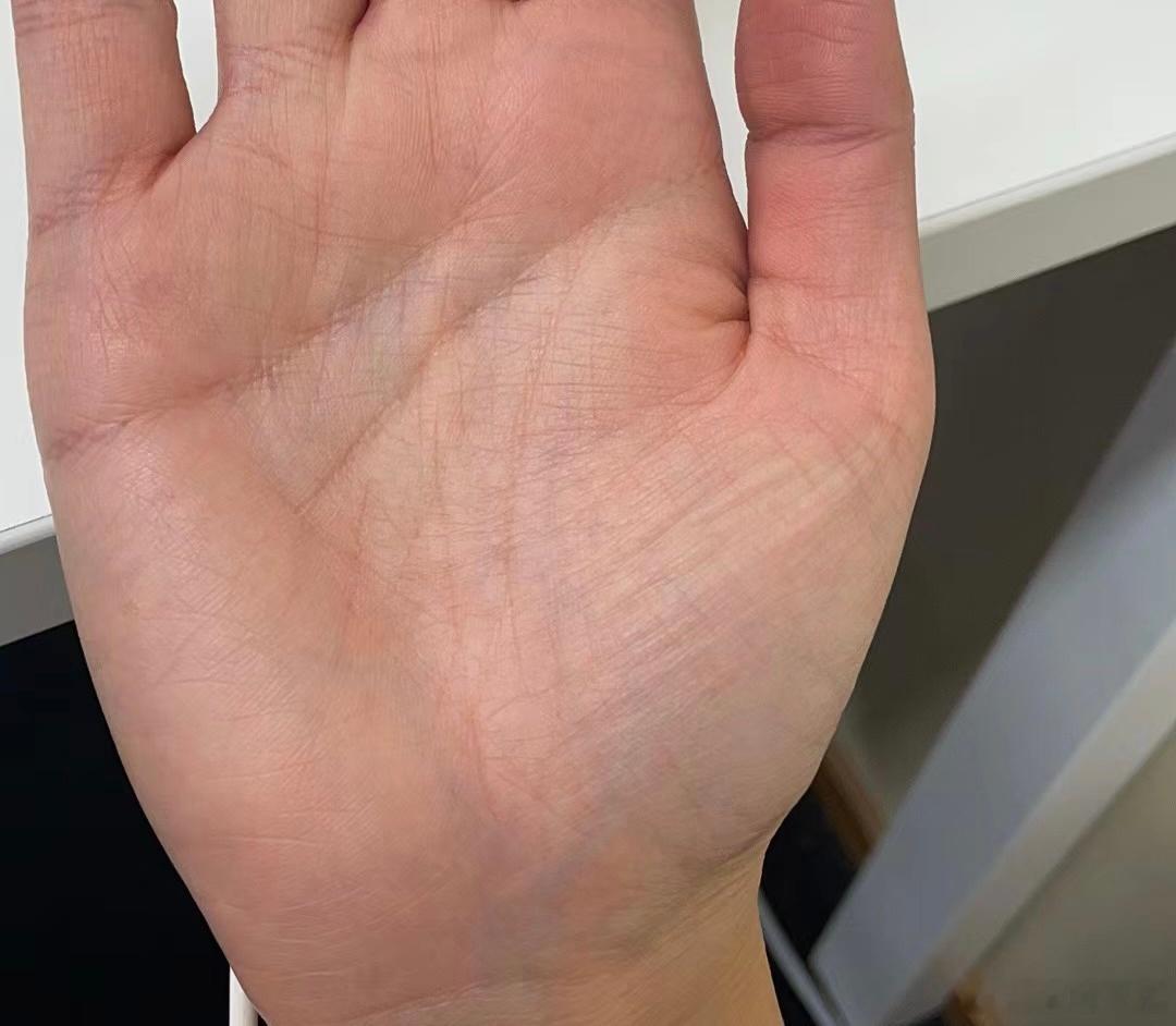 容易患抑郁、焦虑，失眠且工作、财运、感情在35岁前都不顺的手相一则：1、三大线（