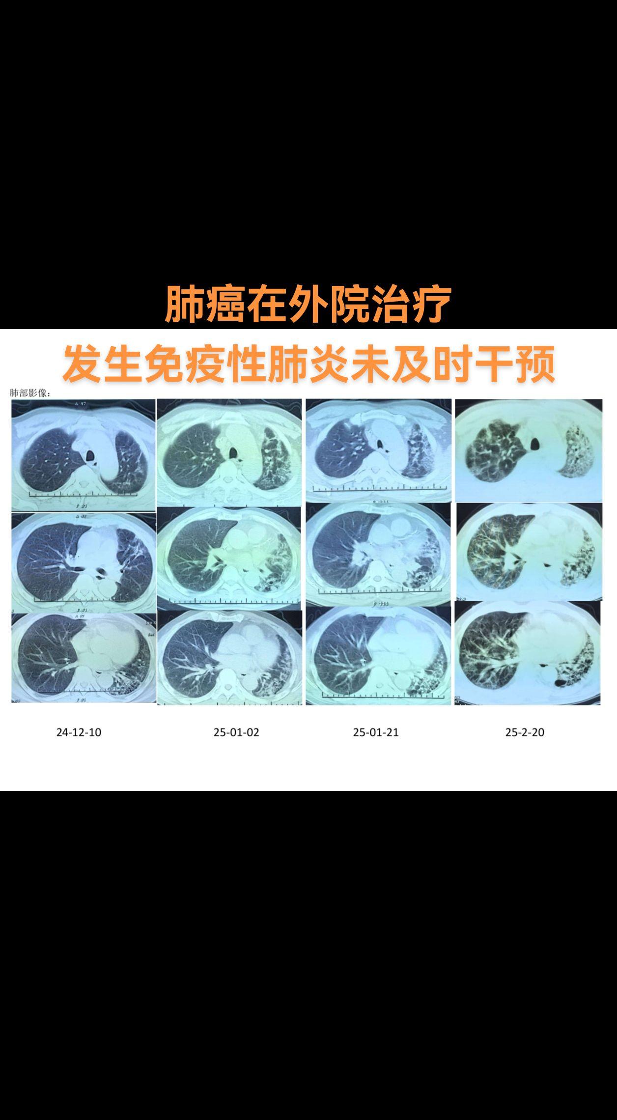 免疫性肺炎。使用PD-1单抗治疗肺癌后，发生免疫性肺炎，呼吸衰竭，激素...