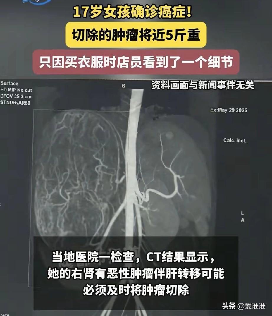 2025年6月，广东汕头，17岁的高二女孩婷婷，她个子一米六出头，体重才八十多斤