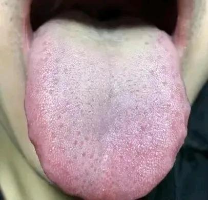 看这个舌象，你以为最大的问题是“湿热＋阴虚”？大错特错，其实真正的病根在气虚
