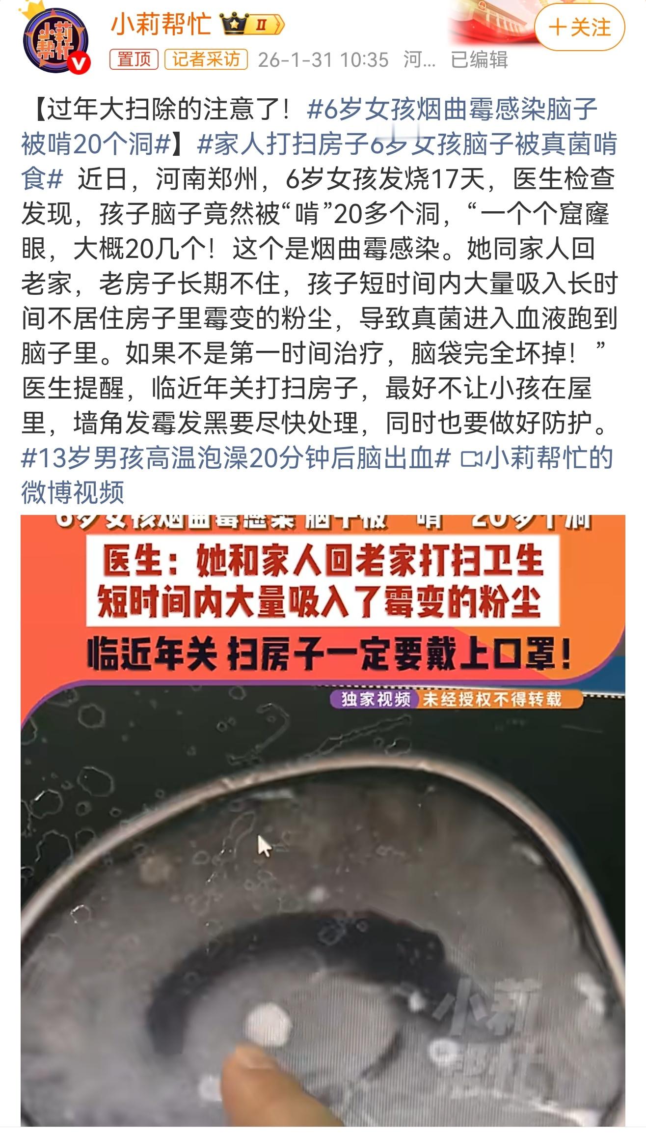 家人打扫房子6岁女孩脑子被真菌啃食 霉菌危害远超想象！其孢子可随灰尘漂浮，极易通