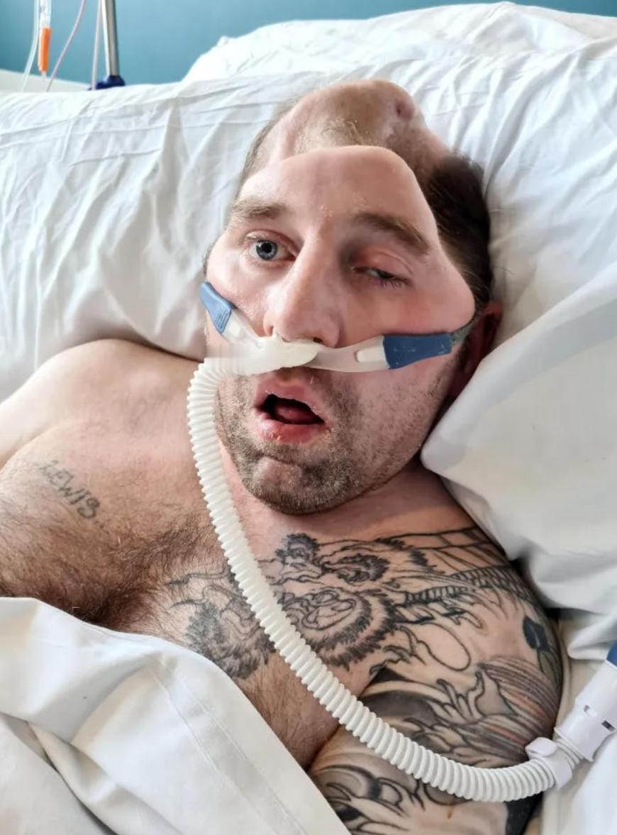 他被打一拳，半个头骨没了！7年生不如死，凶手只判15个月！

谁能想到，一场再普