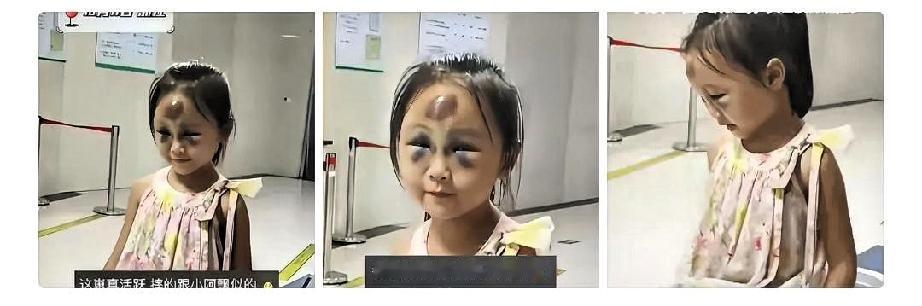 是应该心疼她呢，还是该笑她呢？”浙江一名小女孩因为摔得鼻青脸肿去医院做检查。由于